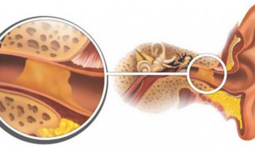 Борная кислота в ухо применение взрослым при беременности. Применение кислоты при лечении ушей