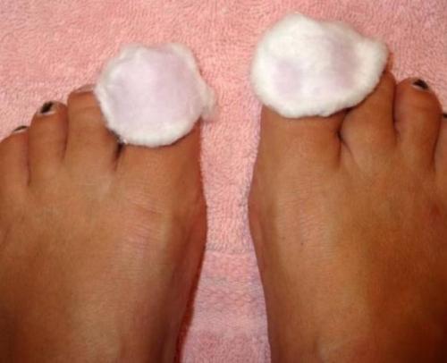 Нашатырный спирт в народной медицине. Нашатырный спирт от грибка ногтей